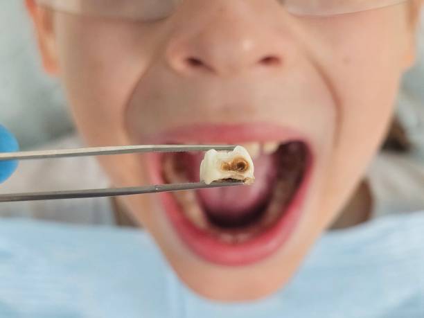 Best Broken or Chipped Tooth Repair in Pocono Ranch Lands, PA